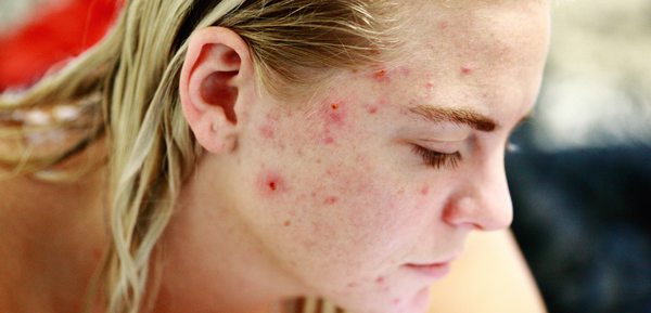 Must-Know Types & Causes Of Acne (US)