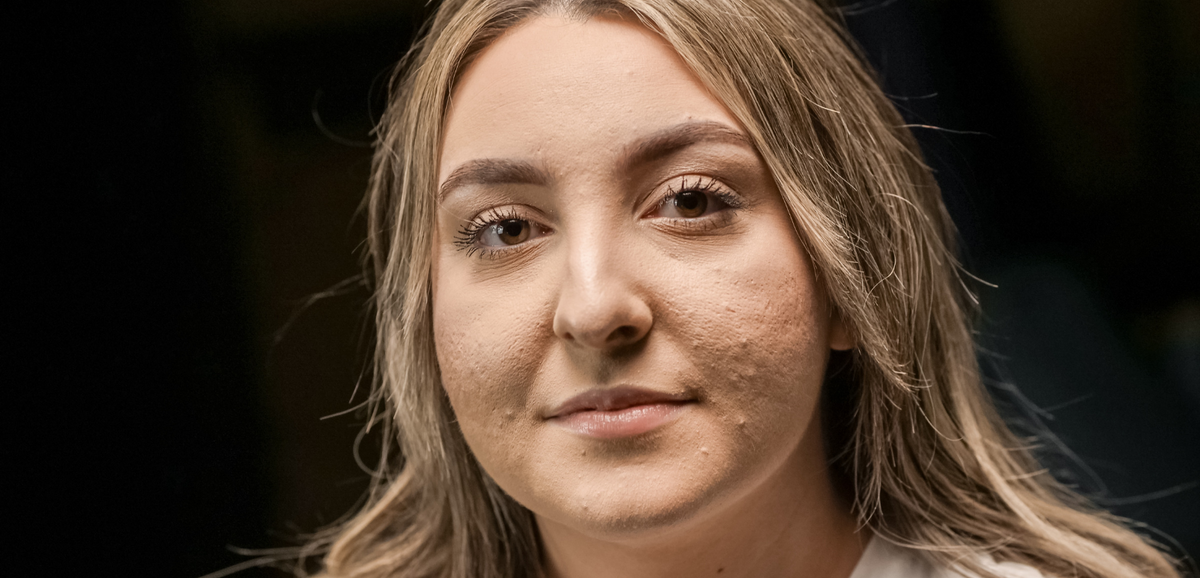 Congested Skin: Everything You Need To Know About It