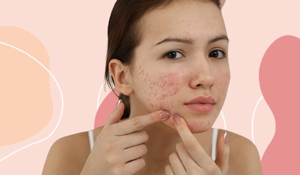 best ingredients for acne prone skin